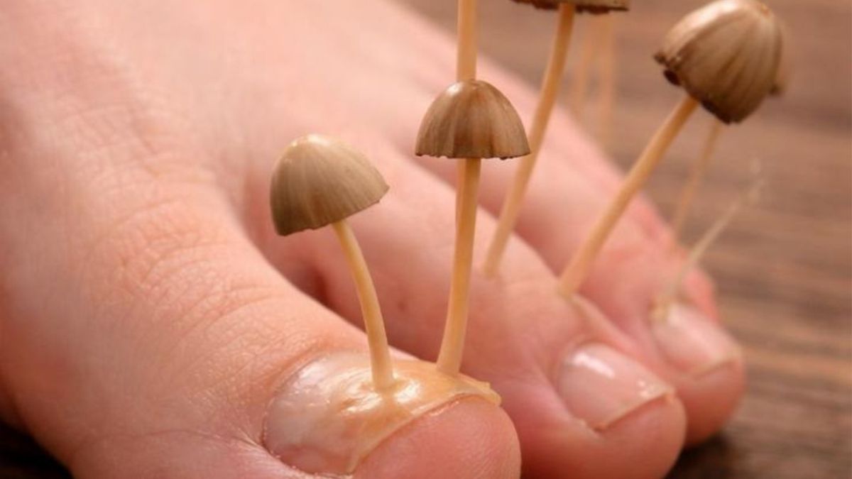Hausmittel gegen Nagelpilz: Was hilft wirklich?