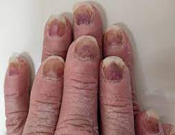 Chemotherapy Nails: Why UV Nail Wraps Can Help During Chemo