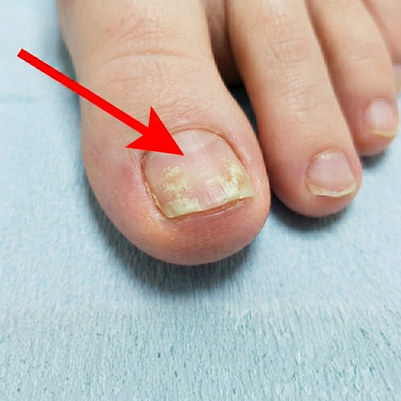 Nagelpilz: Die 4 versteckten Warnsignale – Was sofort hilft