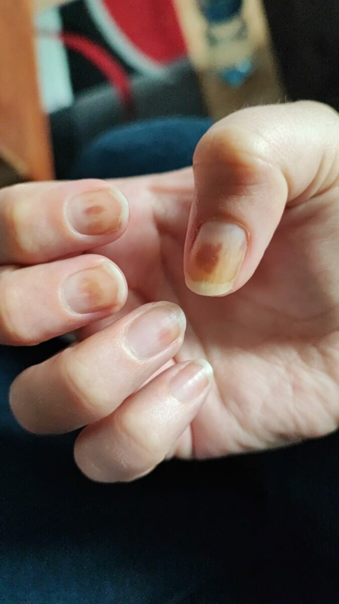 chemotherapie und uv nagelfolien1